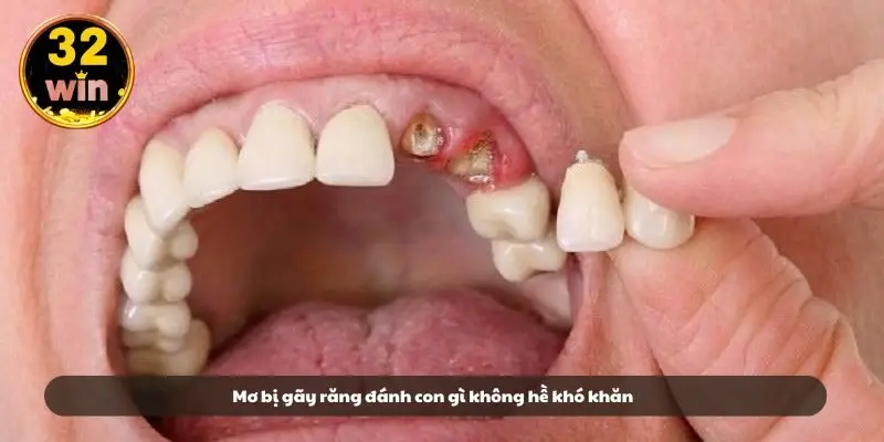 Mơ bị gãy răng đánh con gì không hề khó khăn